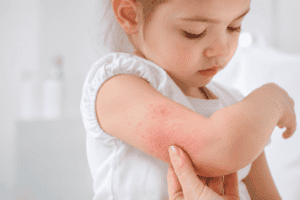 Niña con erupción cutánea en el brazo, posible signo de alergia en la piel infantil.