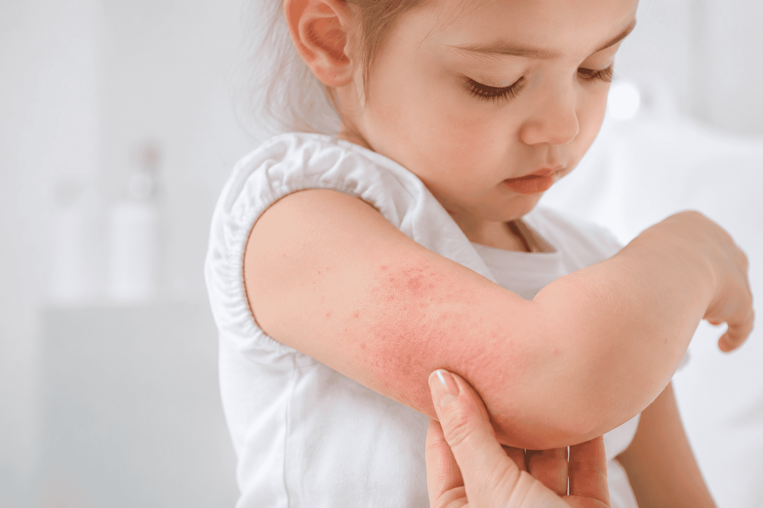 Niña con erupción cutánea en el brazo, posible signo de alergia en la piel infantil.